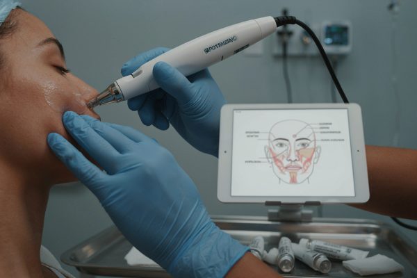 Potenza RF Microneedling Calgary